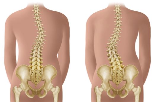 ventajas de la osteopatía para la escoliosis