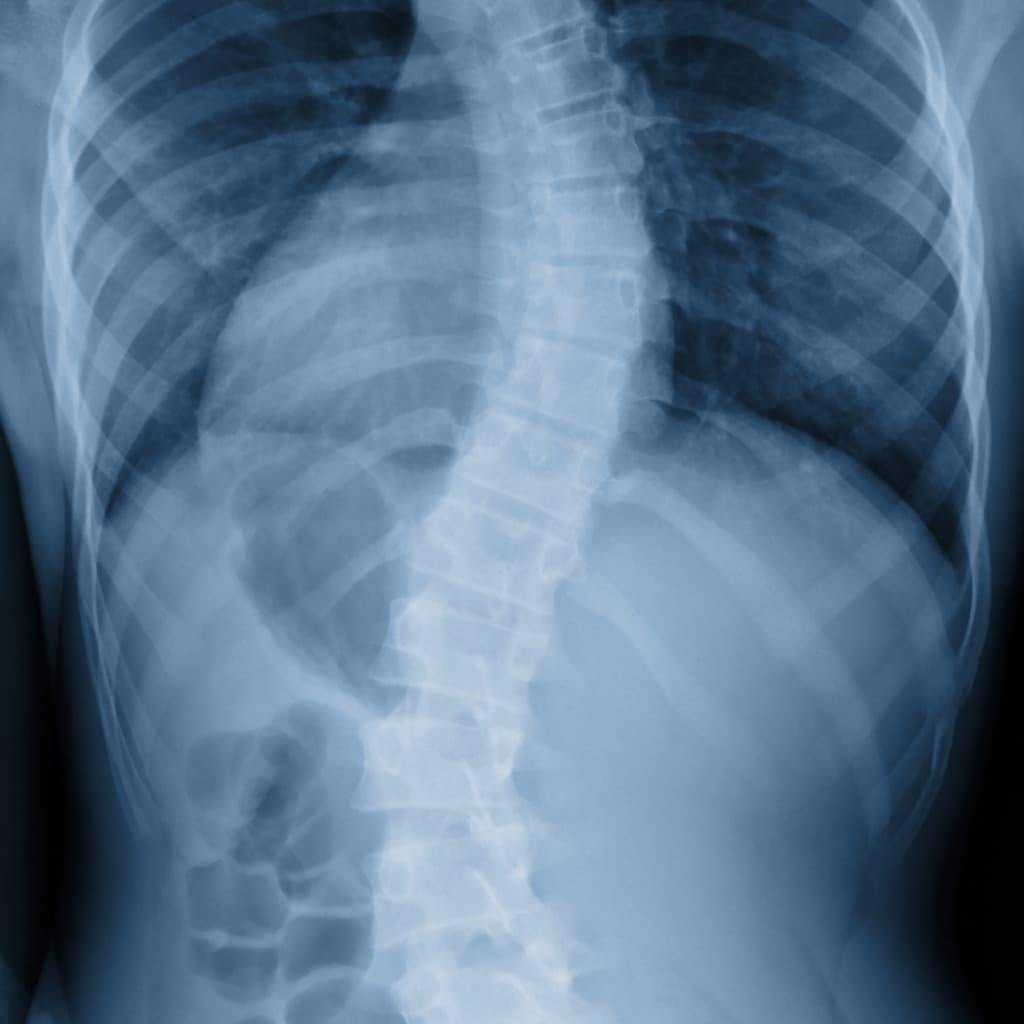 tratamiento escoliosis con osteopatia