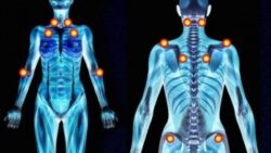 tratamiento del dolor de la fibromialgia